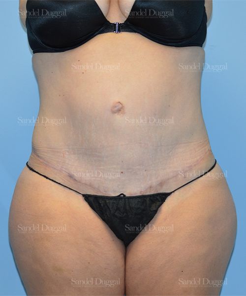 Tummy Tuck after, case 1673