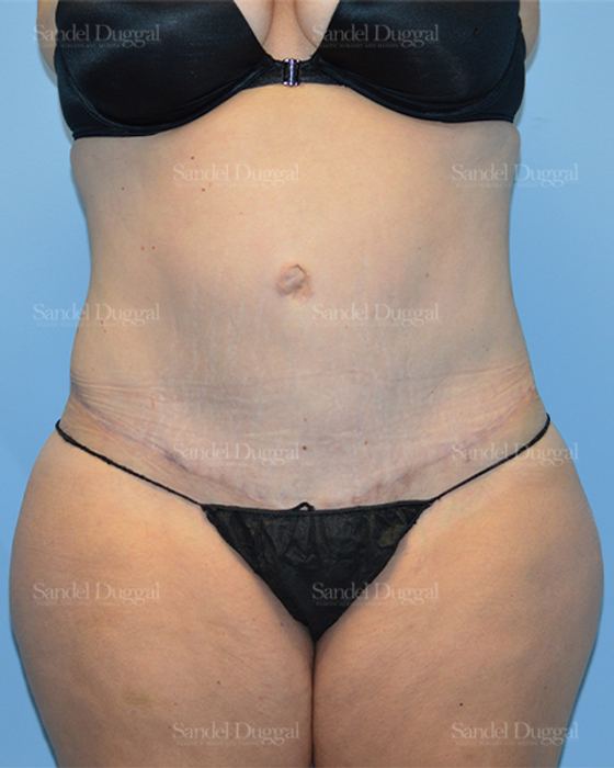 Tummy Tuck after, case 1673
