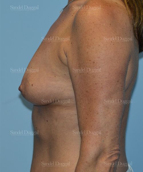 Breast Augmentation before, case 3185