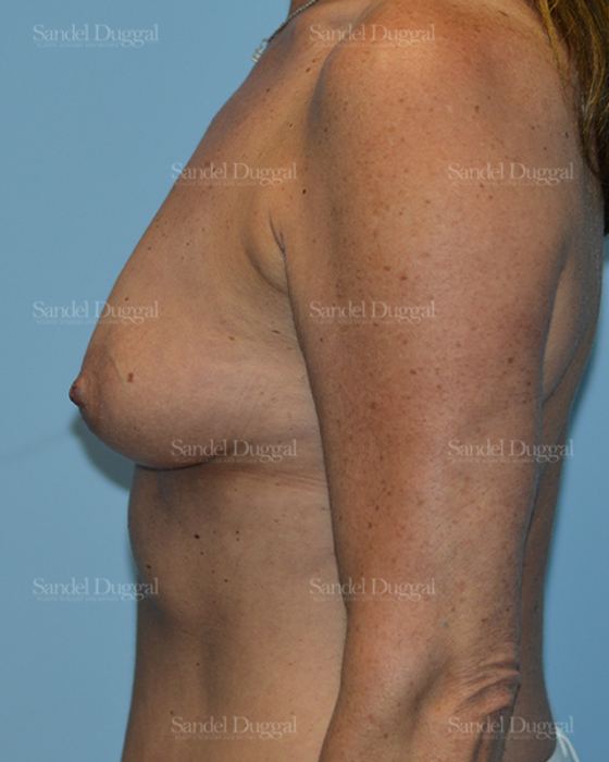 Breast Augmentation before, case 3185