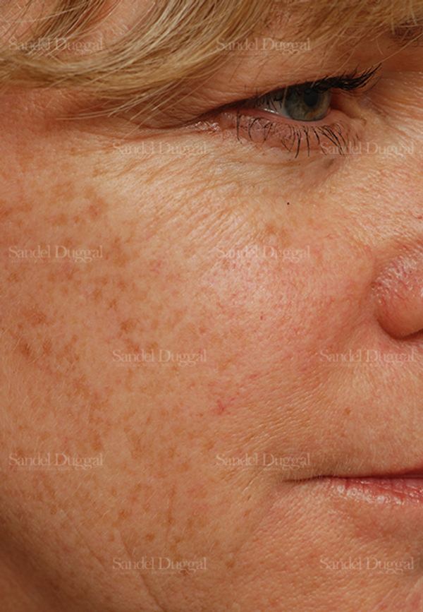 Laser Skin Resurfacing before, case 2947