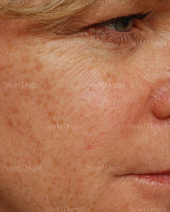Laser Skin Resurfacing before, case 2947