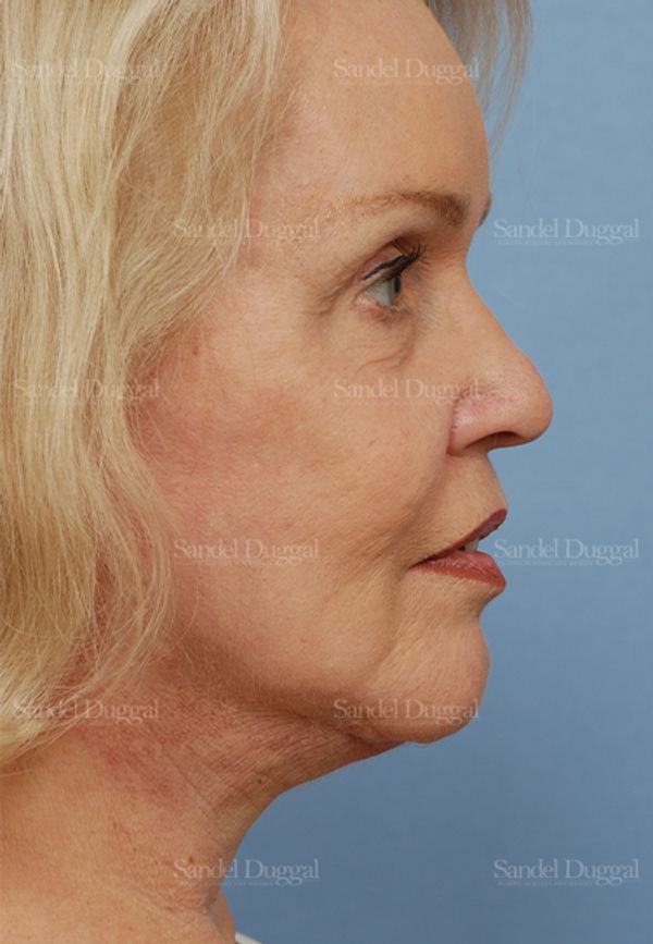 Facelift after, case 2680