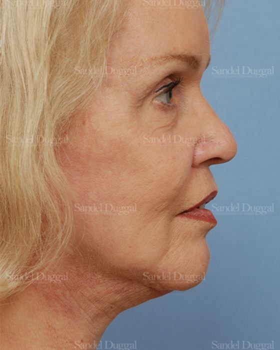 Facelift after, case 2680