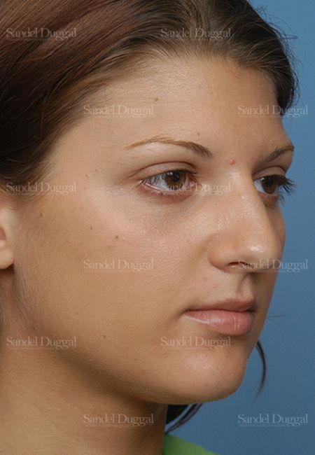 Rhinoplasty before, case 2885