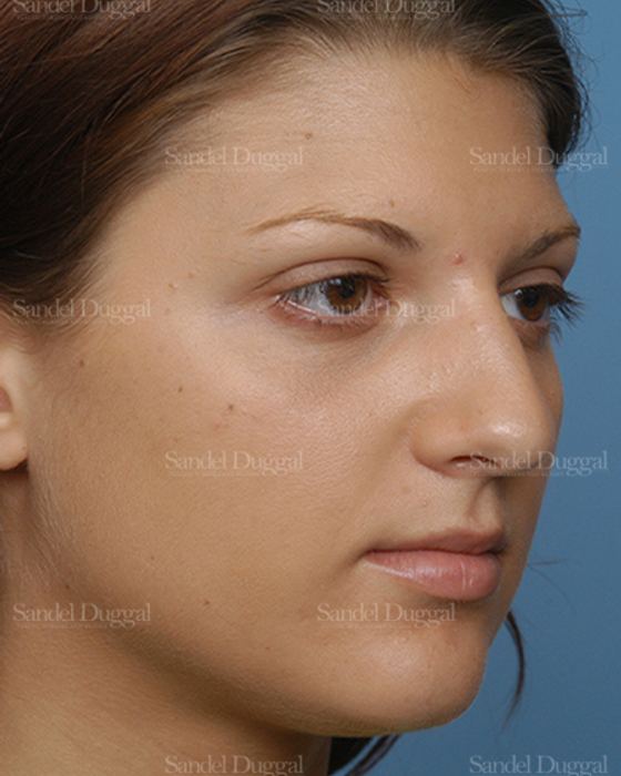 Rhinoplasty before, case 2885