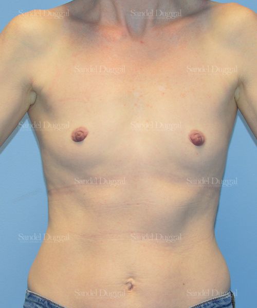 Breast Augmentation before, case 3241