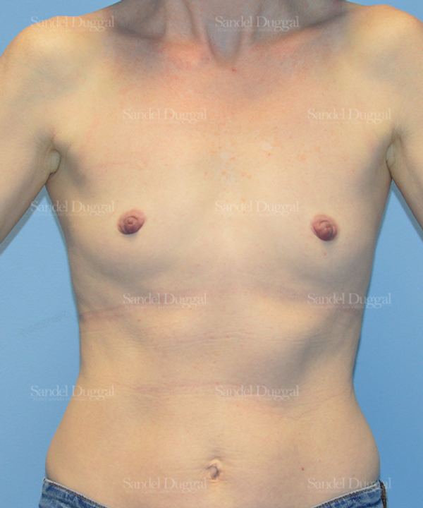 Breast Augmentation before, case 3241