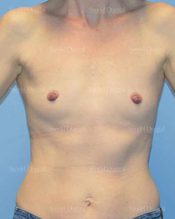 Breast Augmentation before, case 3241