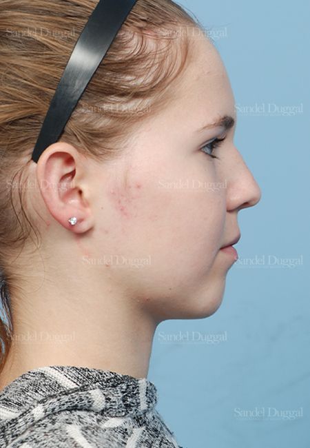 Otoplasty after, case 2598