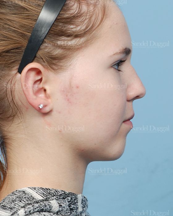 Otoplasty after, case 2598