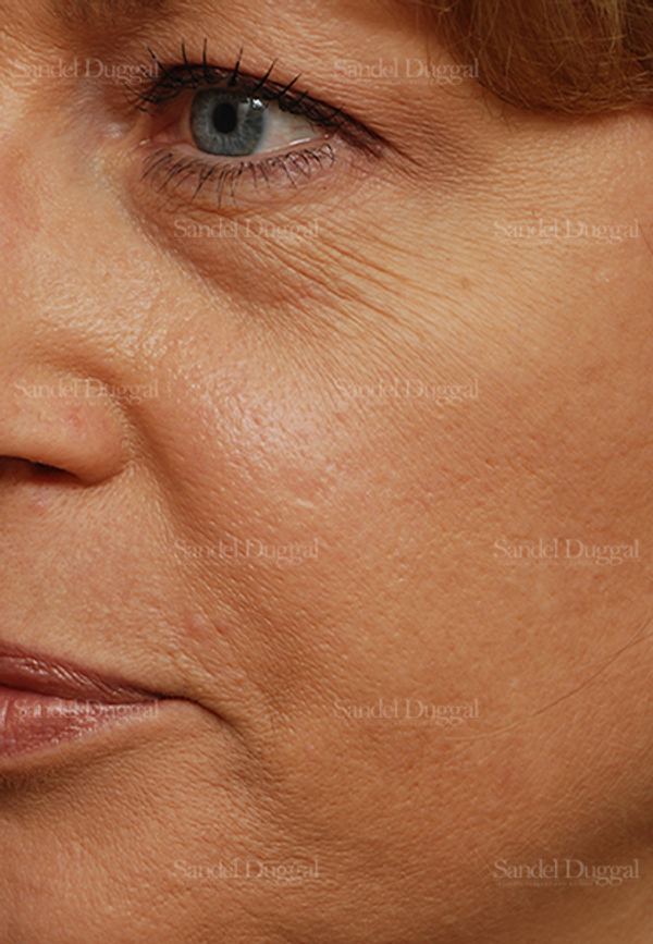 Laser Skin Resurfacing before, case 2923