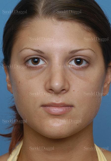 Rhinoplasty after, case 2885