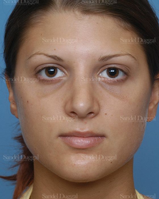 Rhinoplasty after, case 2885