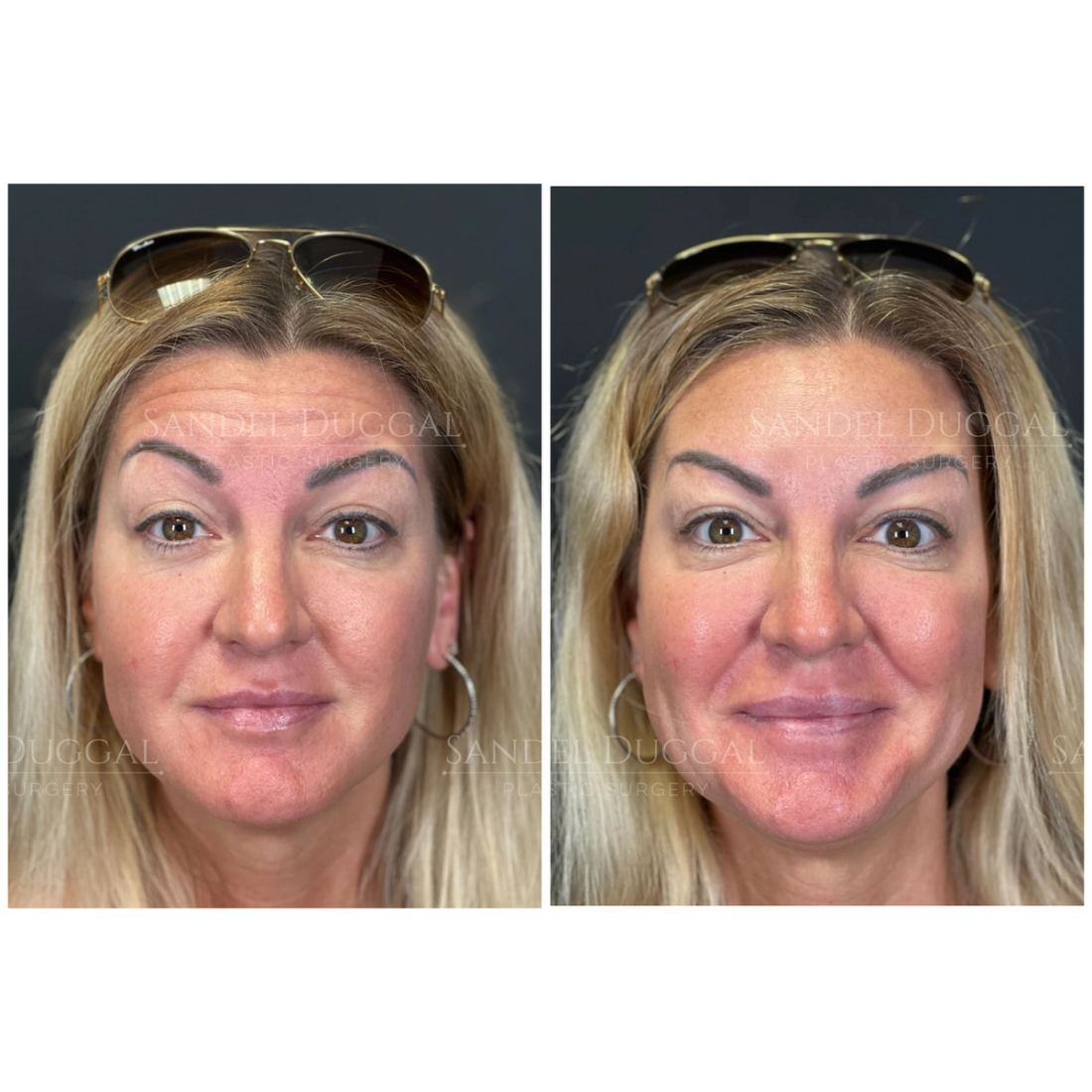Botox & Fillers before and after, case 6010