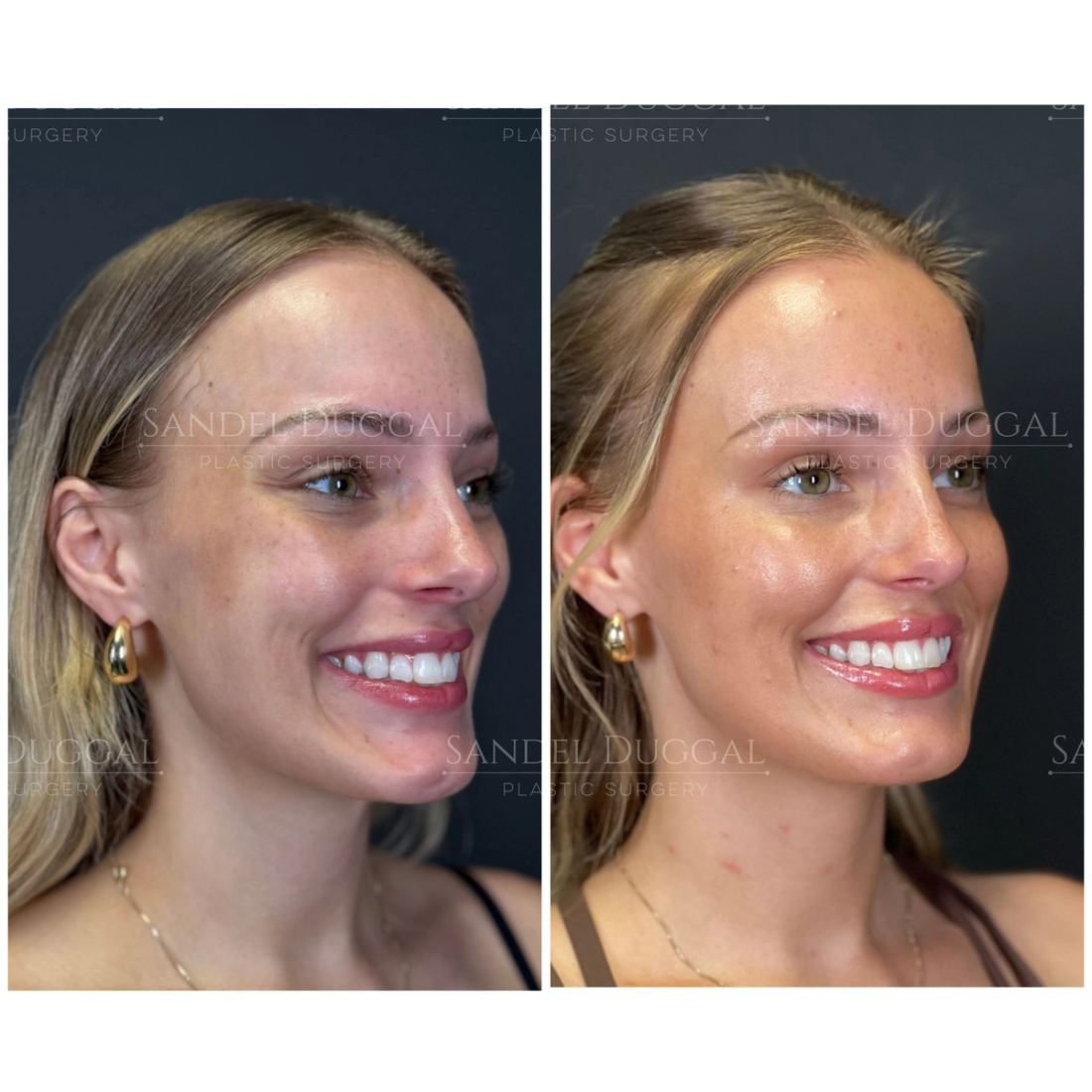 Botox & Fillers before and after, case 6012