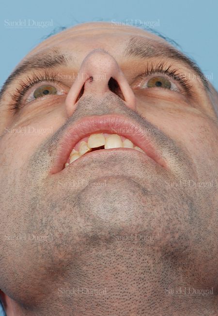Rhinoplasty before, case 2909