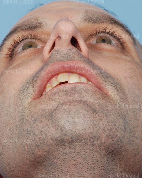 Rhinoplasty before, case 2909
