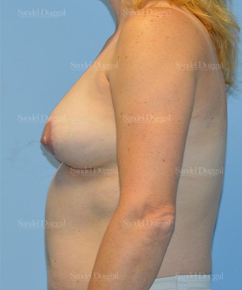 Breast Lift after, case 3294