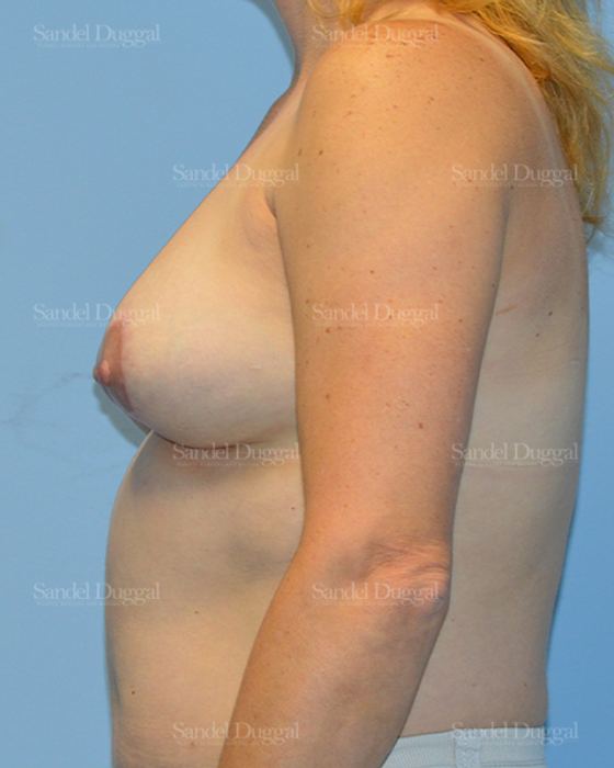 Breast Lift after, case 3294