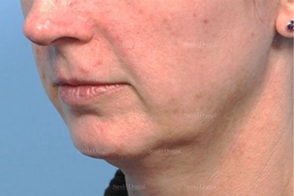 Chin Augmentation before, case 1479