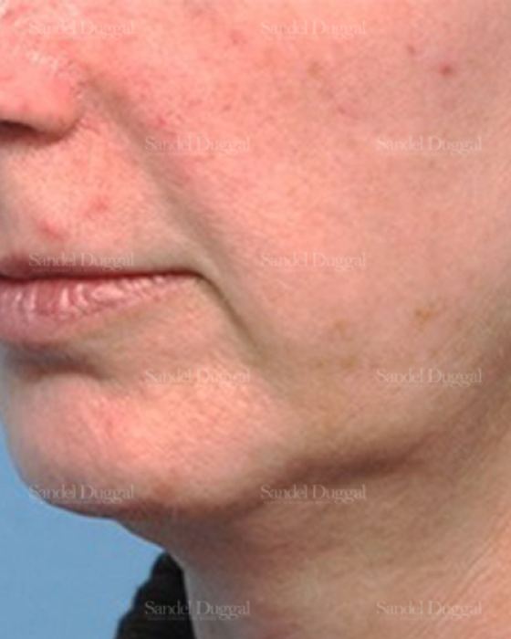 Chin Augmentation before, case 1479