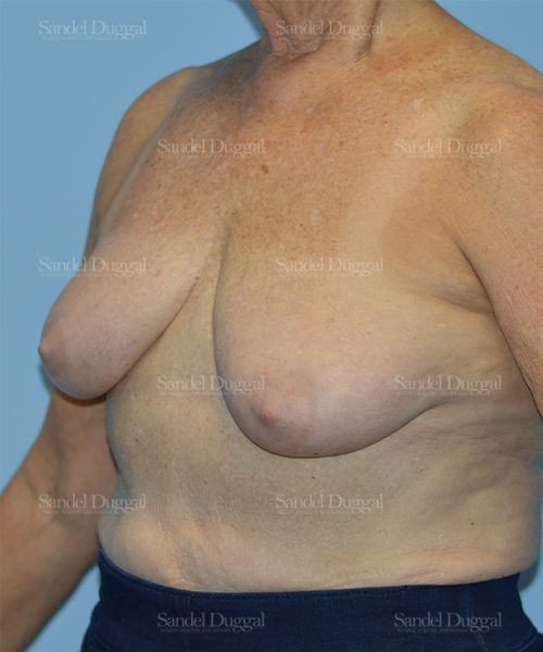 Breast Lift before, case 3315