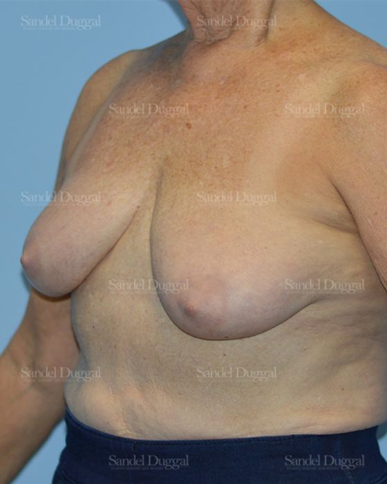 Breast Lift before, case 3315