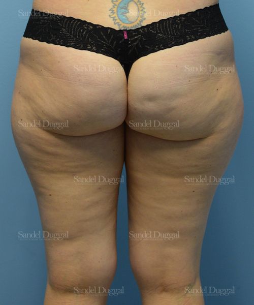 Liposuction — Legs & Flanks before, case 2532
