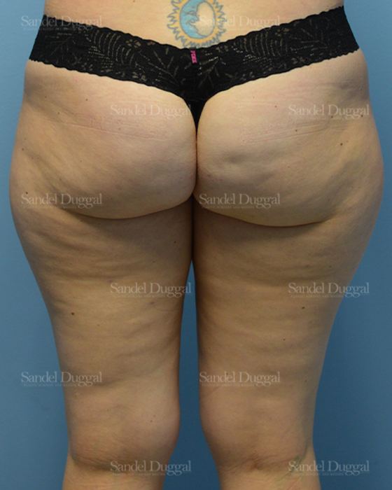 Liposuction — Legs & Flanks before, case 2532