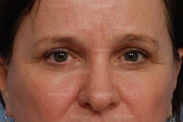 Eyelid Rejuvenation after, case 1980