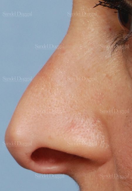 Revision Rhinoplasty before, case 2624