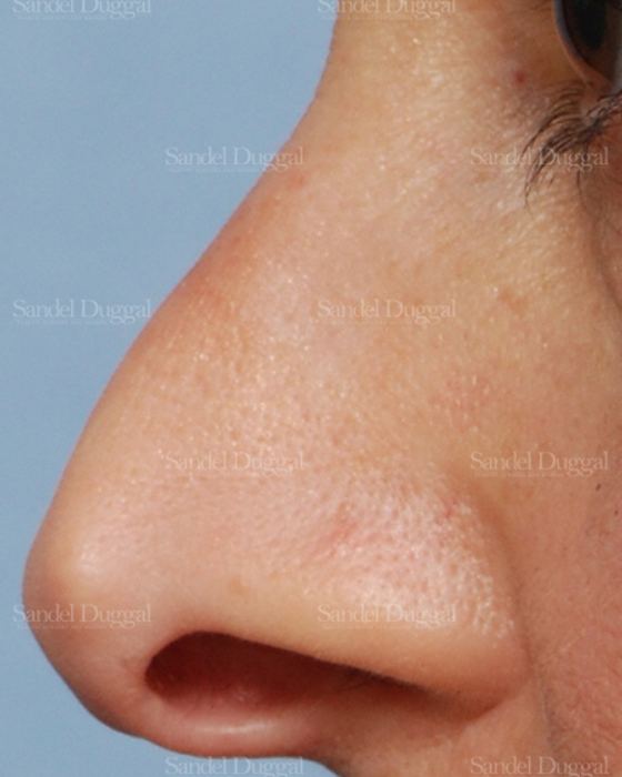 Revision Rhinoplasty before, case 2624