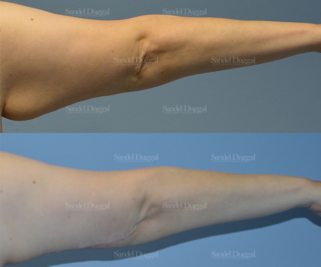 Brachioplasty before and after, case 2134