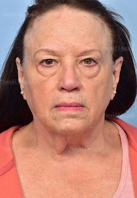 Facelift before, case 5351