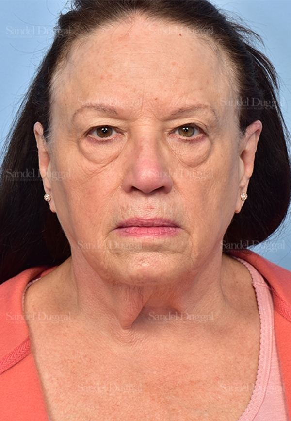 Facelift before, case 5351