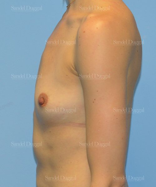 Breast Augmentation before, case 3087