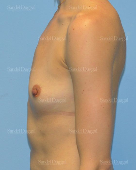 Breast Augmentation before, case 3087