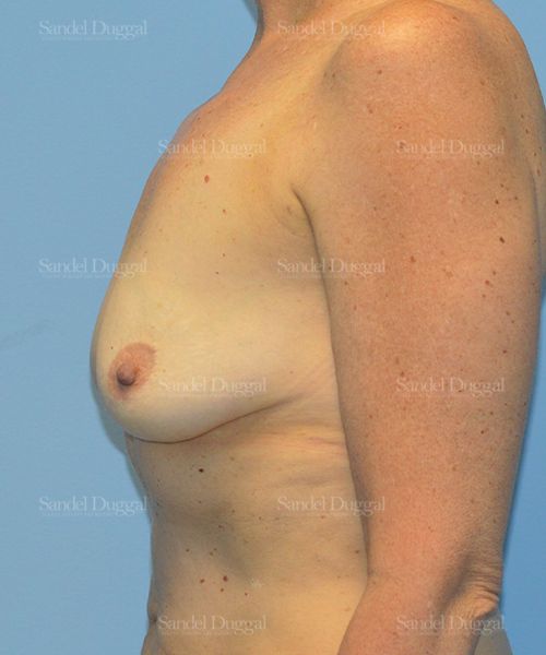 Breast Augmentation with Lift before, case 3414