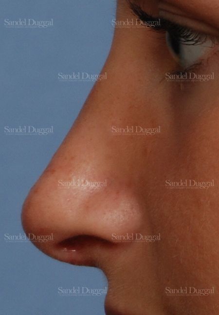Rhinoplasty after, case 2876