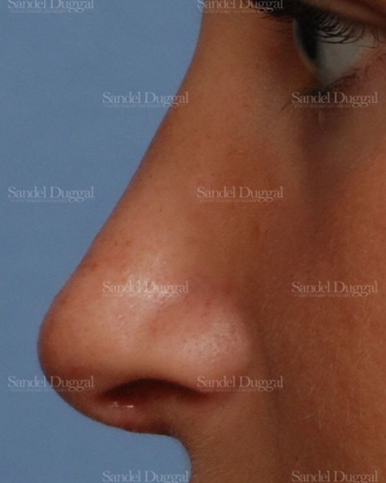 Rhinoplasty after, case 2876