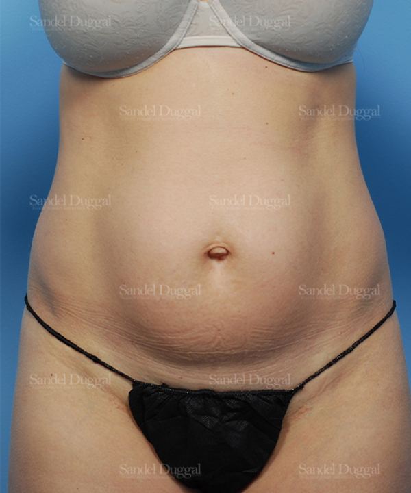 Liposuction — Abdomen before, case 2474
