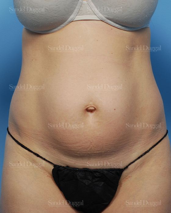 Liposuction — Abdomen before, case 2474