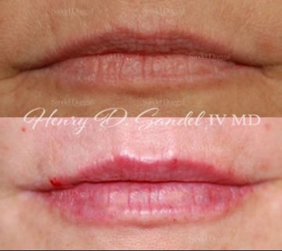 Lip Augmentation / Lip Lift before and after, case 4389