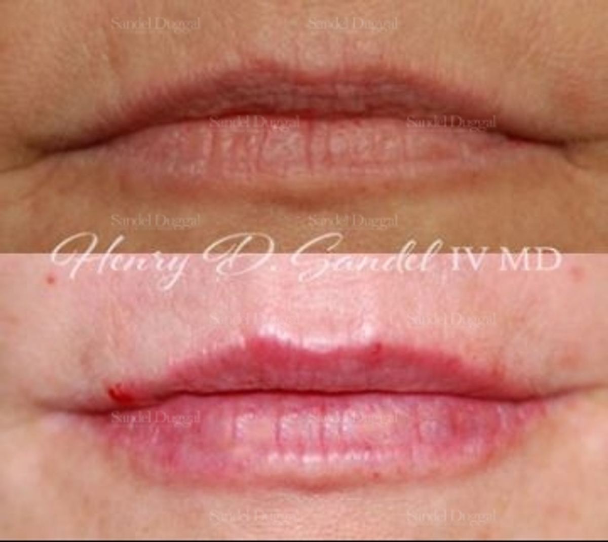 Lip Augmentation / Lip Lift before and after, case 4389