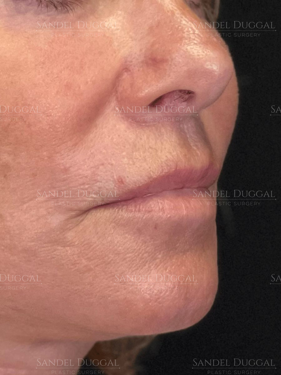 Subnasal Lip Lift after, case 6004