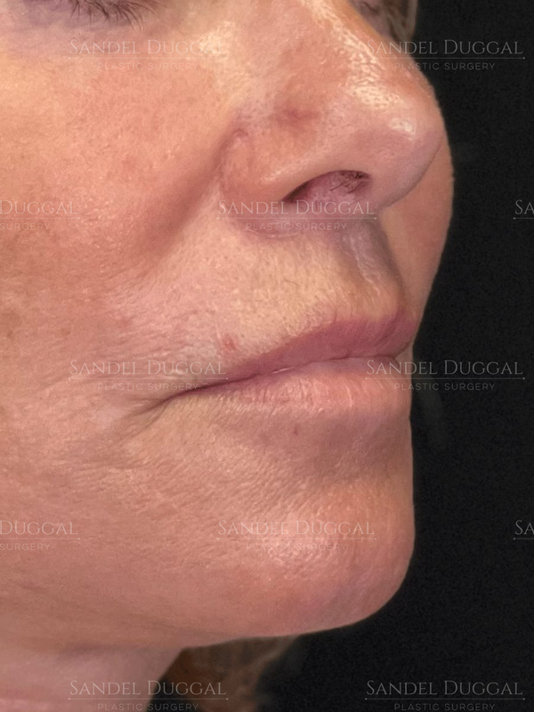 Subnasal Lip Lift after, case 6004