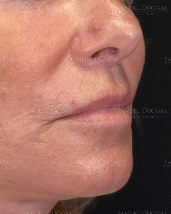 Subnasal Lip Lift after, case 6004