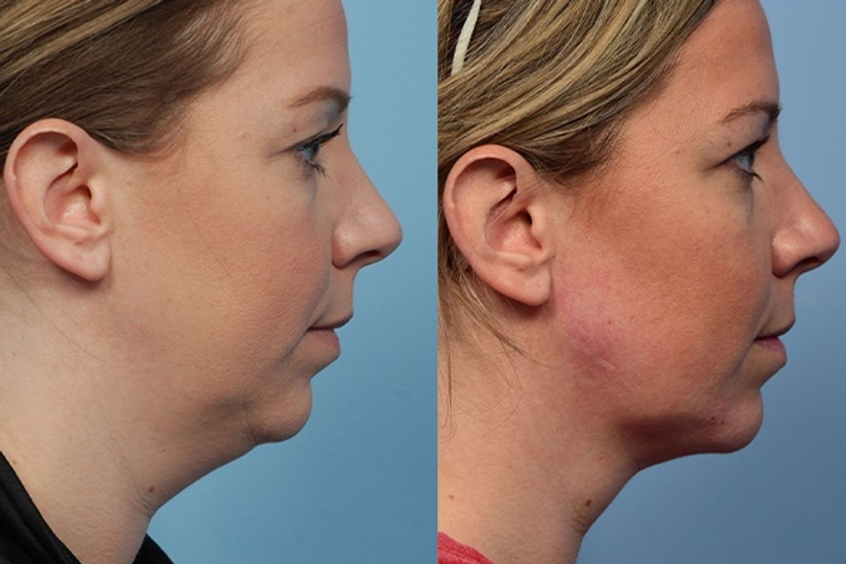 Neck & Chin Liposuction before and after, case 2550