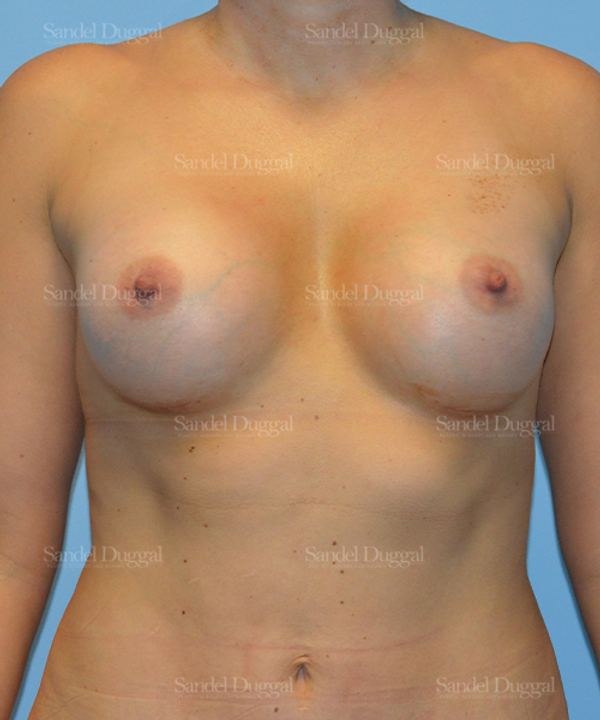 Breast Augmentation after, case 3122